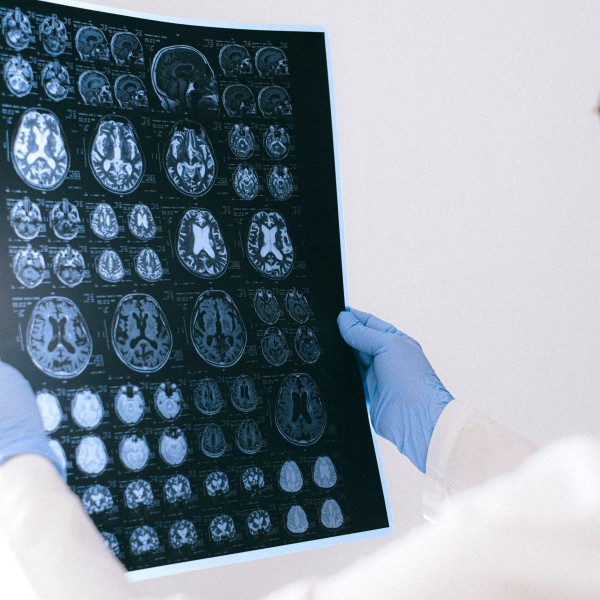 a doctor holds a sheet with brain scan images