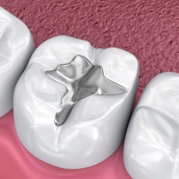 Illustration of three teeth with a metal filling in the middle tooth.