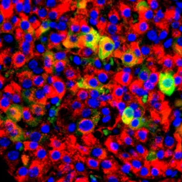 Gene for enzyme in saliva associated with Type 2 diabetes